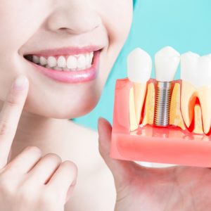 Salud-bucodental-los-implantes-dentales